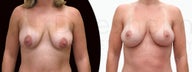 Breast lift and implants and fat grafting