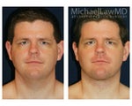 Liposuction