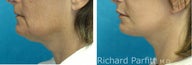 Submental Liposuction in combination with Facelift