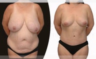 38 year old woman Tummy Tuck, Breast Reduction and Liposuction
