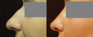 .29 Year Old Female Treated for Nose that had a Dorsal Hump, Bulbous and Droopy Nasal Tip