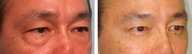 Asian Male Blepharoplasty