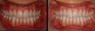 Porcelain Veneers, Subtle Upgrade
