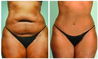 Abdominoplasty and Smartlipo of the abdomen and hips