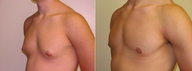 Male Breast Reduction