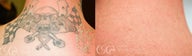 tattoo removal