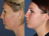 PDT & Fraxel Restore Before and After