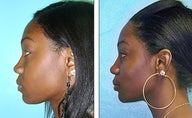 Nose Job- Rhinoplasty