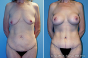 Body Lift