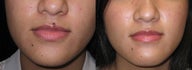 Mole Removal photos