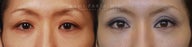 Before and After Upper and Lower Eyelid Blepharoplasty Surgery