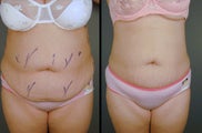 Tumescent Liposuction
