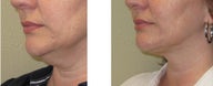 Chin liposuction/Liposculpture