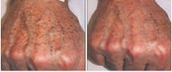Hand Rejuvenation with IPL Photorejuvenation
