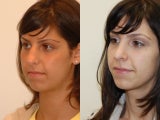 Rhinoplasty Surgery. 7-years post-op.