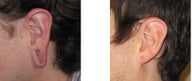 gauge earlobe repair, earlobe reconstruction