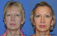 Brow Lift