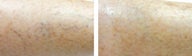 VeinGogh Thermolysis Thermocoagulation of Leg Spider Veins