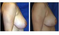 Breast Lift