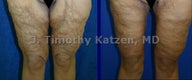 Leg Lift after weight loss surgery