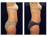 Liposuction