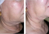 Thermage Skin Tightening for the Neck