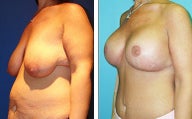 Breast Lift- Mastopexy