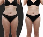 Body-jet (water liposuction) liposuction for lower body