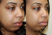 Lip Reduction Surgery.