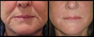 56 year old lady for lower third facial volume loss treated with 3ml Restylane dermal filler