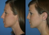 Rhinoplasty