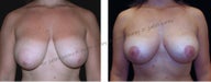 Breast Lift