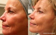 Liquid facelift using only Radiesse Filler