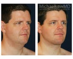 Liposuction