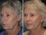 Laser Resurfacing