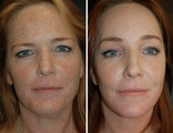 Laser Resurfacing