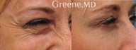 Botox treatment to minimize the appearance of crows feet