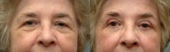 Face Laser & Eyelid Surgery