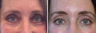 Before and after Botox Brow Lift