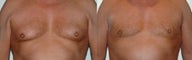 BodyTite liposuction