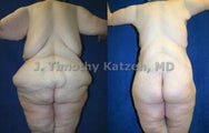 Torso Back Reduction