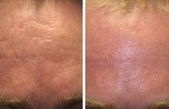 Before and after Acne Scar Removal with Laser