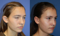 Otoplasty