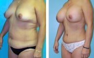 Breast Lift- Mastopexy