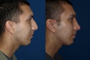 Rhinoplasty