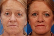 Laser Resurfacing Before & After