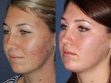 PDT & Fraxel Restore Before and After