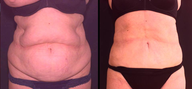 Liposculpture