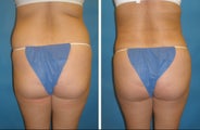 Cleveland butt augmentation