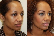 African Rhinoplasty Surgery. 1 month post-op.